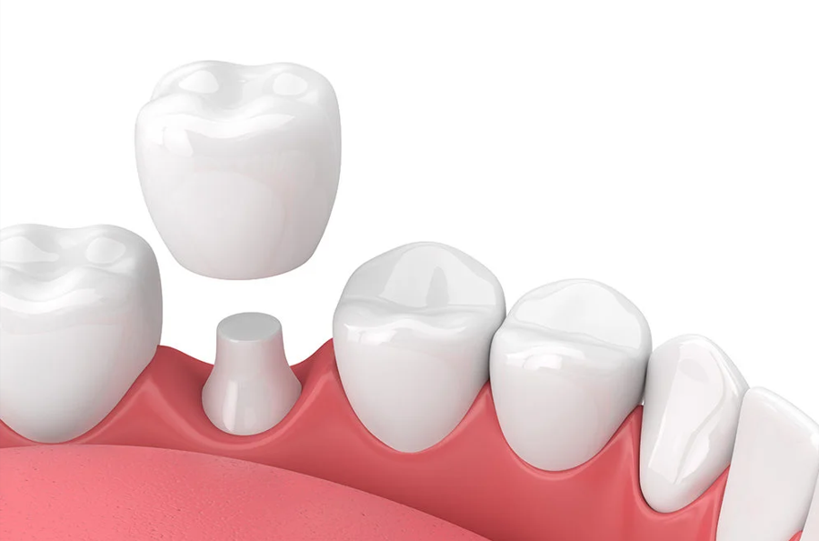 Dental crowns