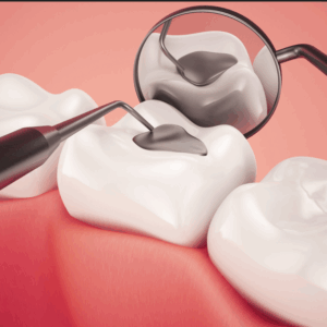 Dental fillings