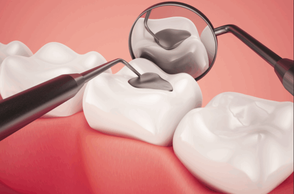 Dental fillings