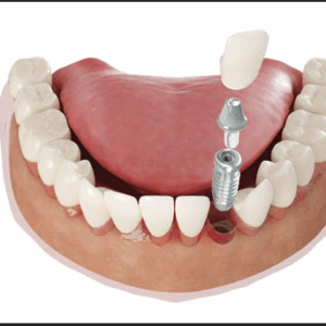 Dental implants