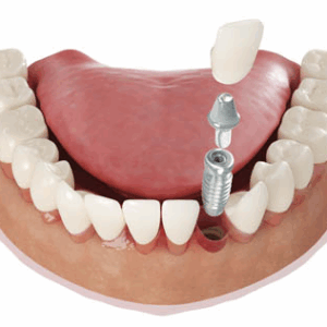 Dental implants