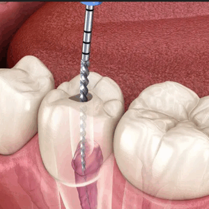 Root canal
