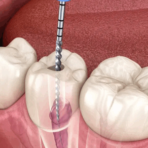 Root canal