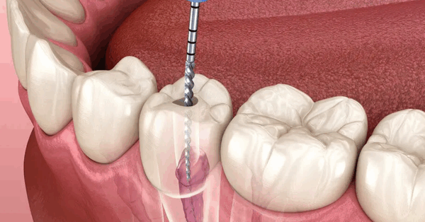 Root canal