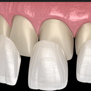 Veneers