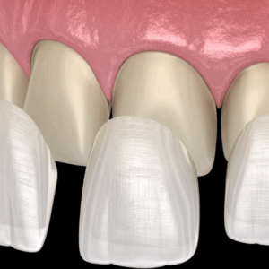 Veneers