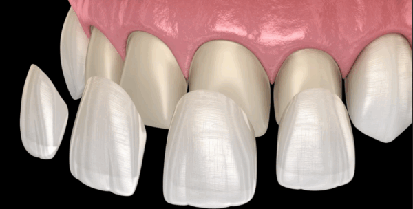Veneers